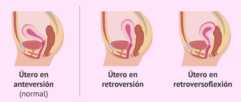 Cómo afecta el útero invertido las posiciones de coito