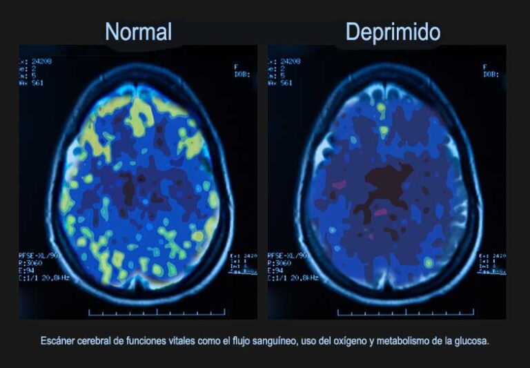Depresión: Cómo es el cerebro de una persona con depresión