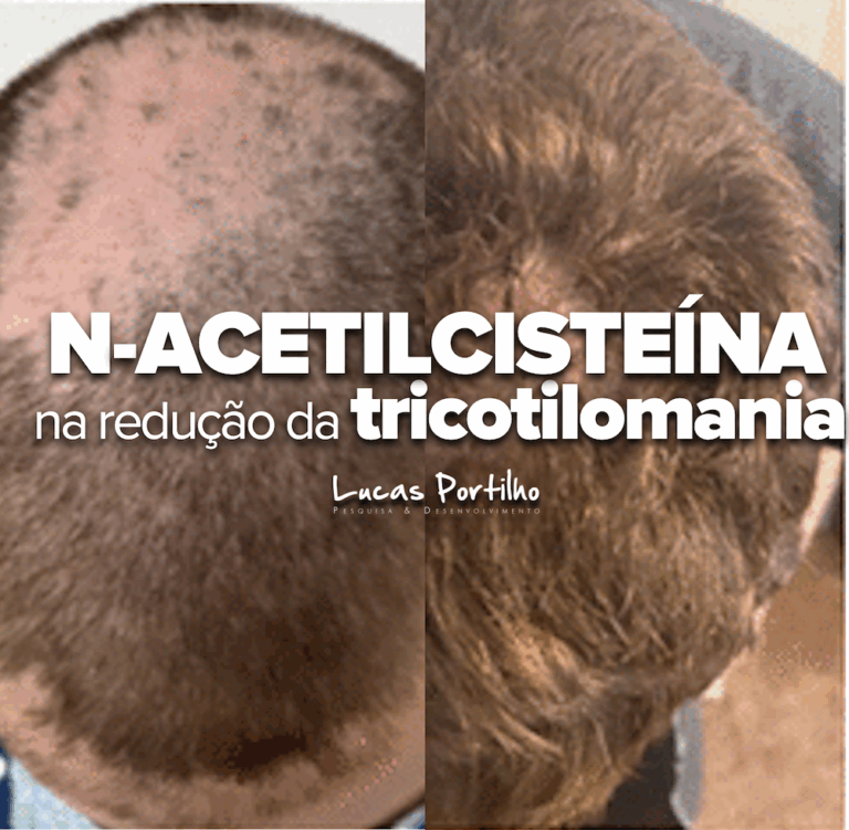 Es la N-acetilcisteína un tratamiento para la tricotilomanía