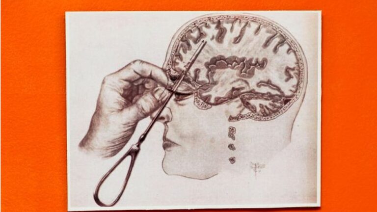 Lobotomía Química: Definición y Efectos en la Salud Mental