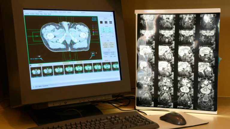 Los tumores cerebrales imitan trastornos alimentarios.