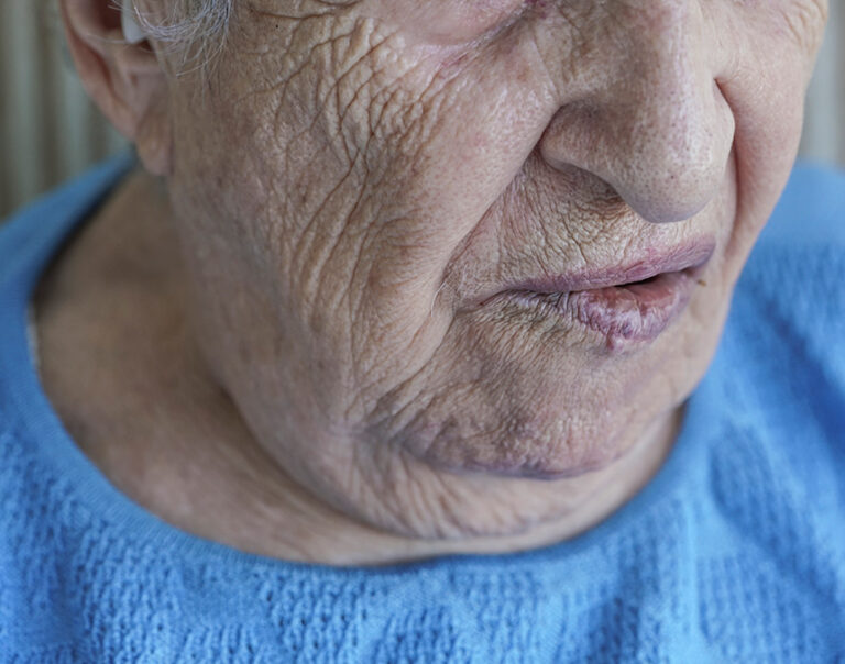 Parálisis facial por estrés: impacto en la percepción social