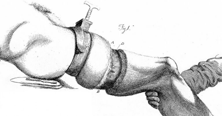 Qué es la apotemnofilia y sus efectos psicológicos