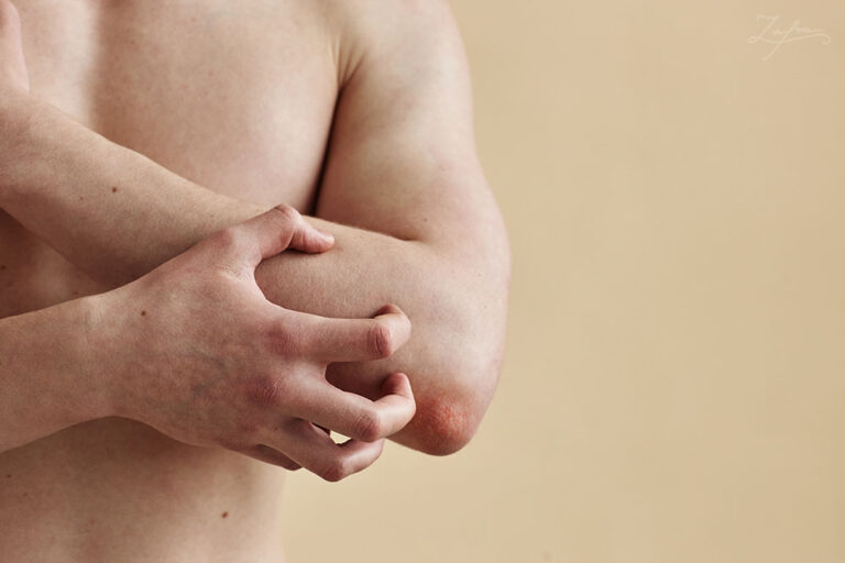Qué es la dermatillomanía y su relación con el TDAH